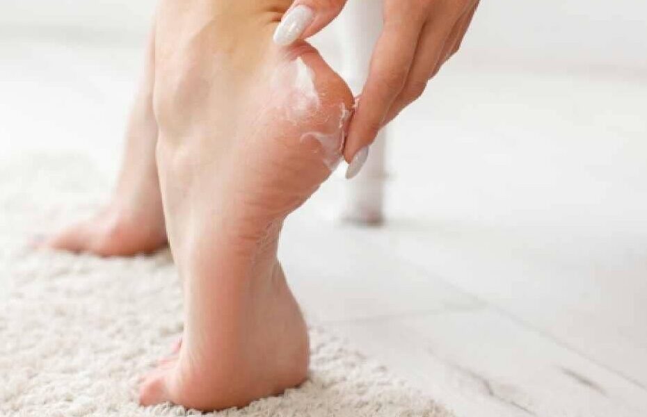 Cea mai buna crema calcaie crapate